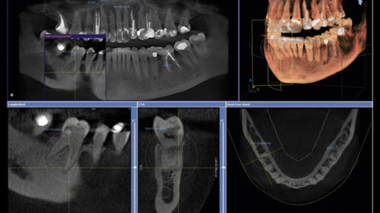dental cone beam scan