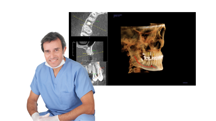 CBCT for Implants