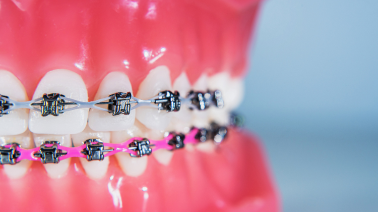 metal braces orthodontics