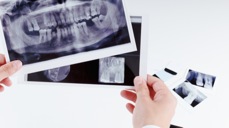 Traditional Dental X-Rays