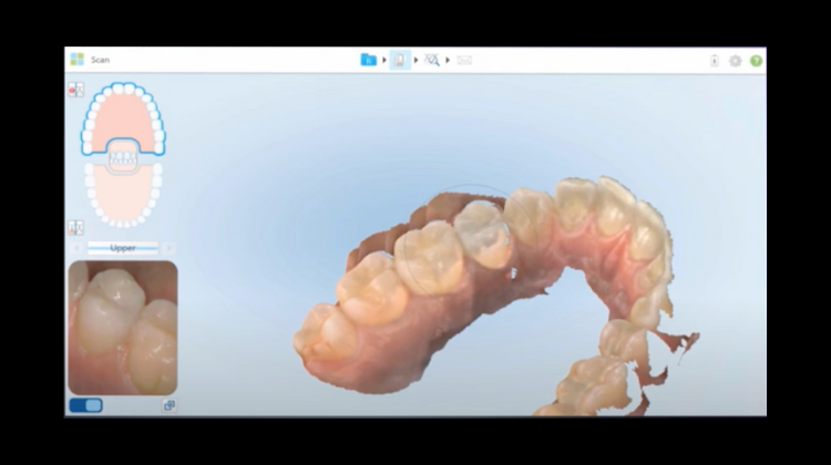full arch implants itero scanner