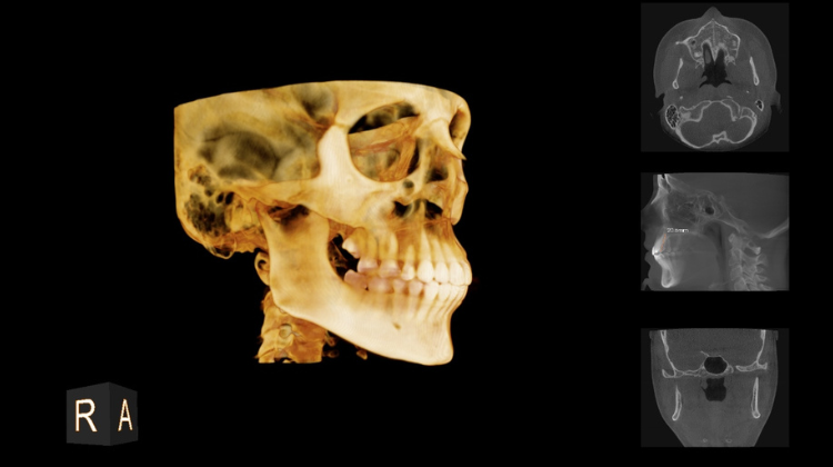 dental cone beam scan